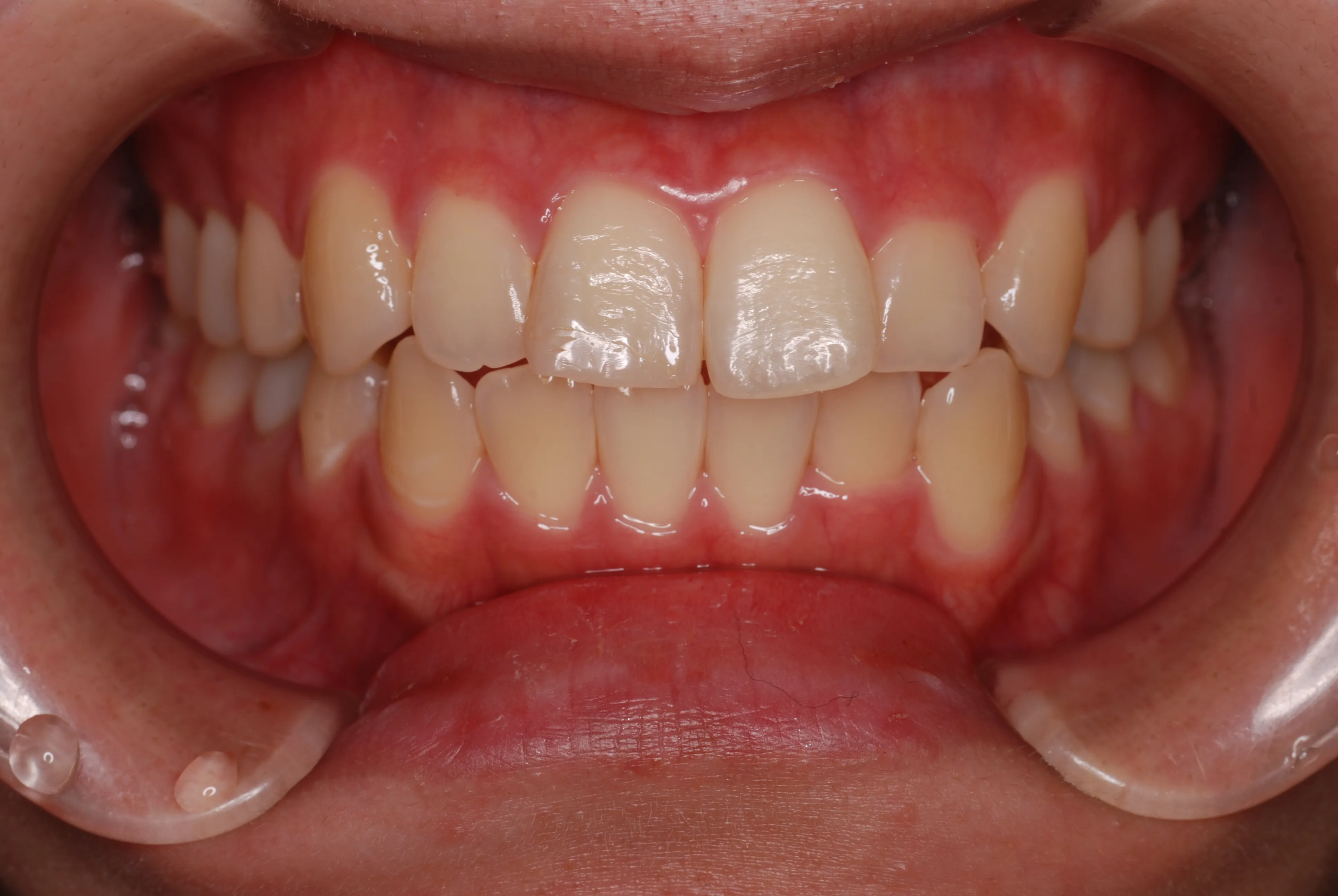 CASE5 Before